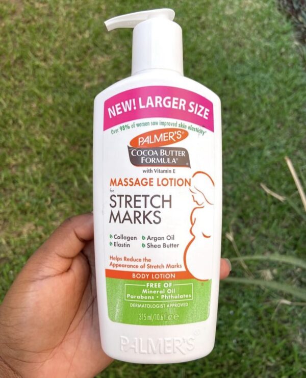 palmer’s stretch marks
