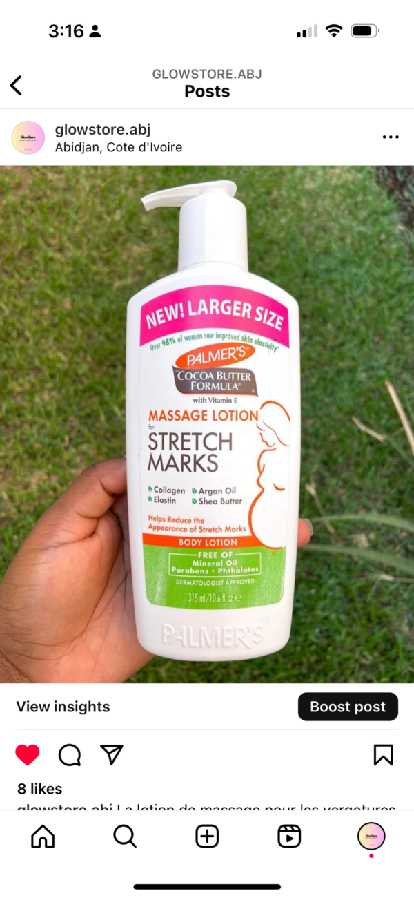 palmer’s stretch marks